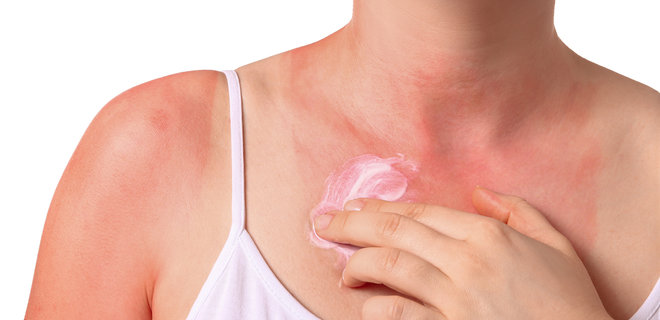 Алергія на сонце: як проявляється та що робити з нею в спеку. Пояснює алерголог - Фото