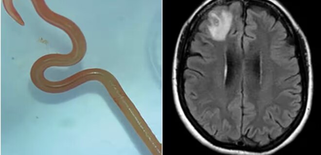 В Австралії в мозку жінки знайшли живого хробака завдовжки 8 см - Фото